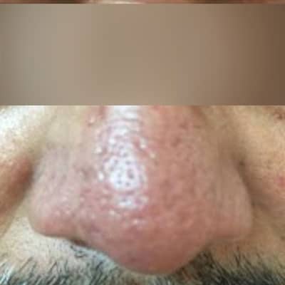 Rosacea und Couperose