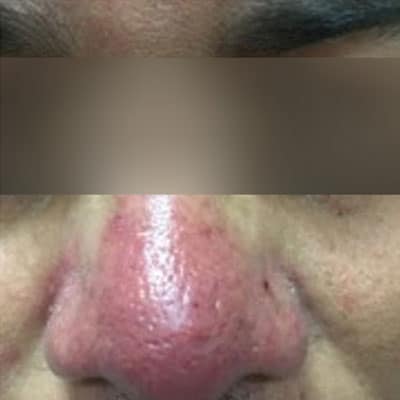 Rosacea und Couperose