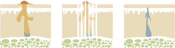 Akne