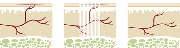 Couperose