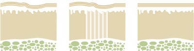 HAUTVERJÜNGUNG