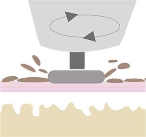 Mikrodermabrasion