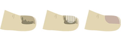 NAGELPILZ