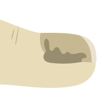 Nagelpilz