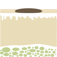 Pigment-, Altersflecken
